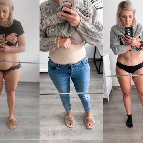 abdominoplastika před a po